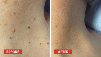 Derma Smooth Skin Tag Removal Patch (72 patches)